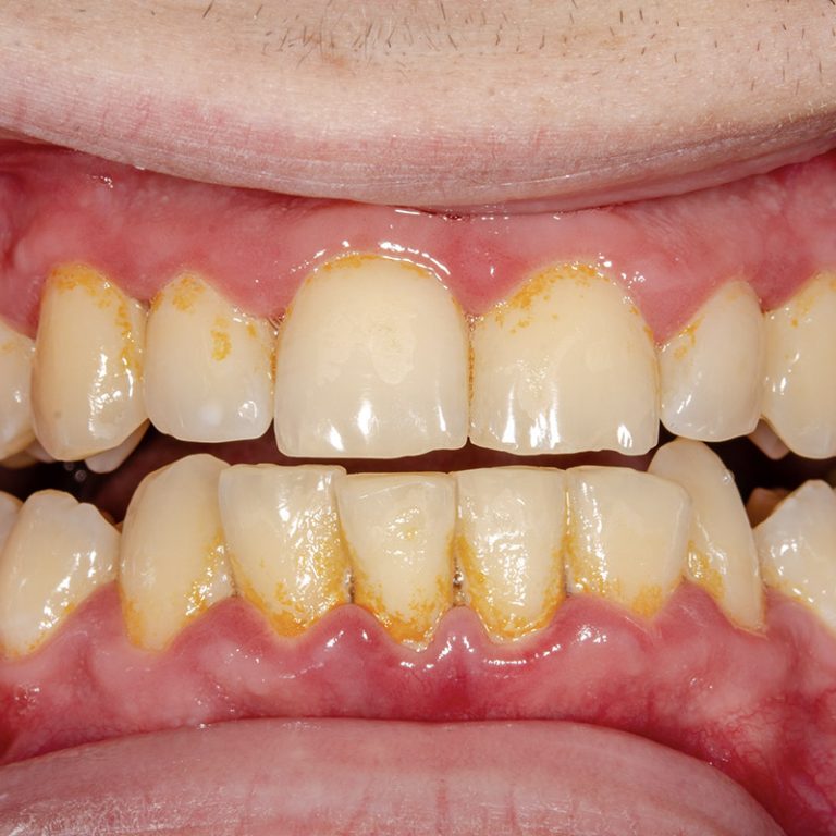 Zahnstein entfernen Wie werden Sie Zahnstein los?